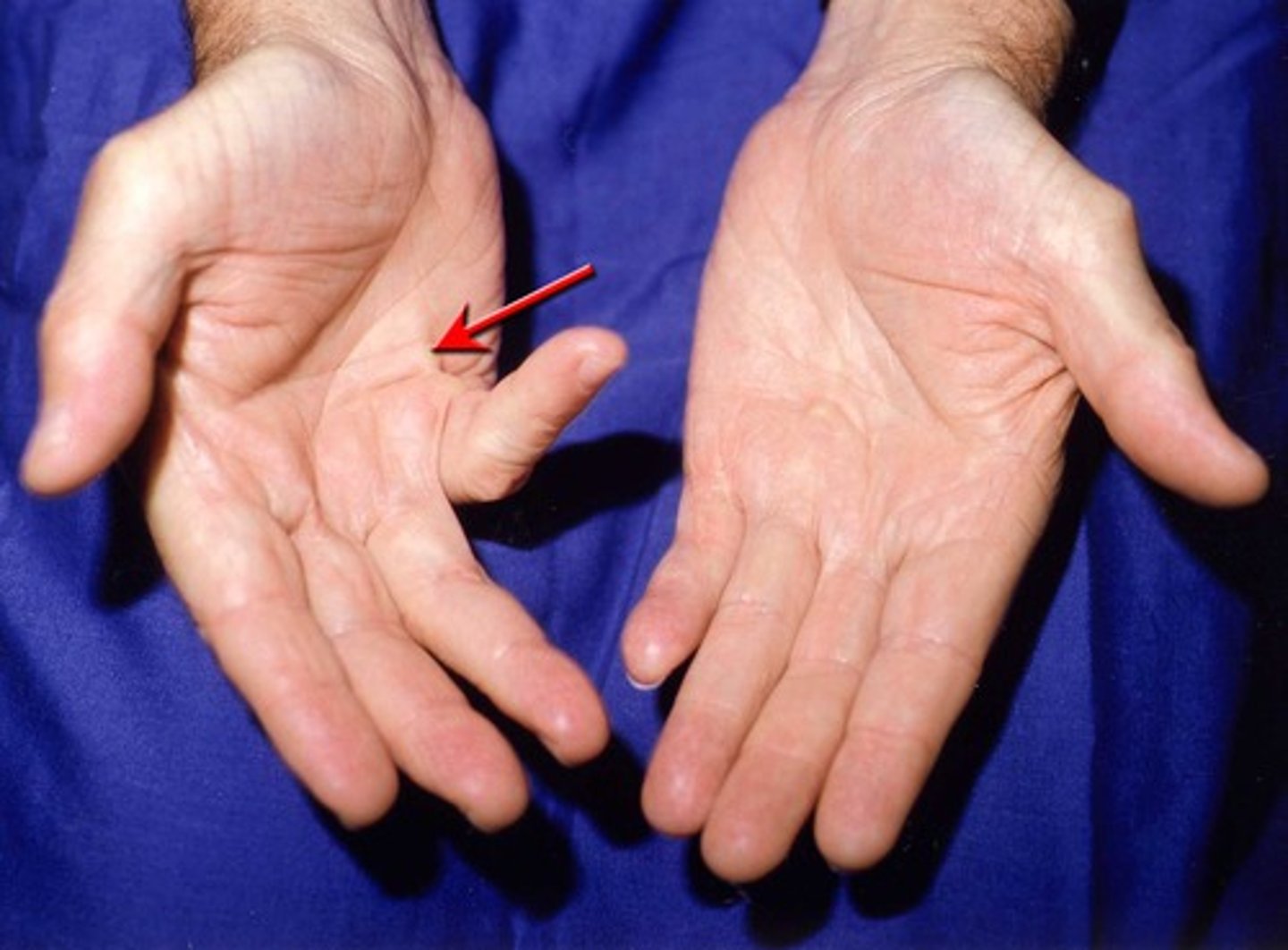 <p>involved fingers assumes excessiviely flexed resting position. Inability to passively or actively extend the MCP and PIP joints. affects the 4th and 5th fingers</p>