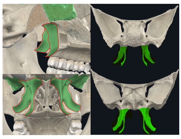 <p><span>cara externa de las coanas</span></p><p><span>Forma hendidura pterigomaxilopalatina con el palatino y la tuberosidad del maxilar</span></p>