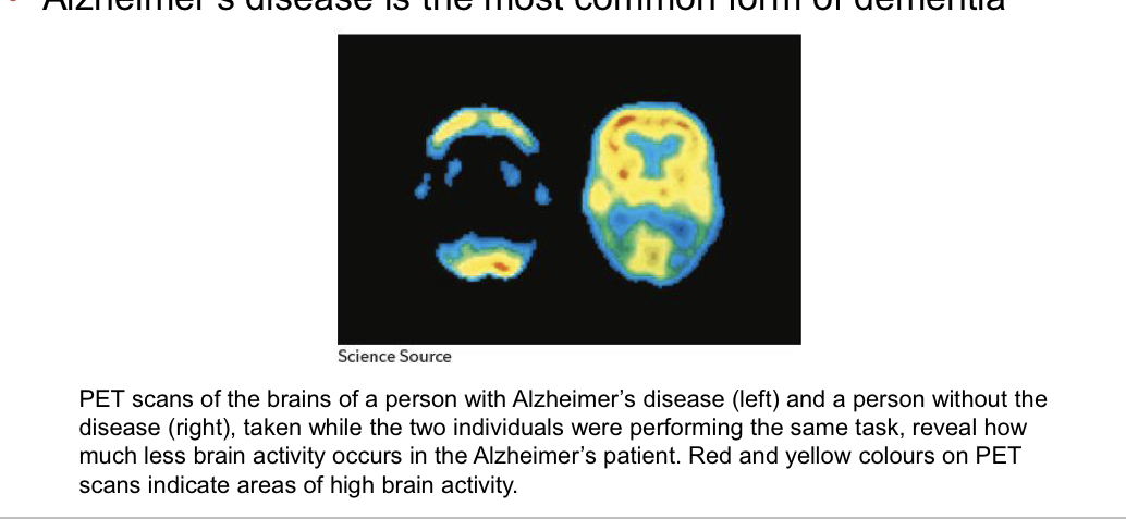 <p>severe memory problems combined with losses in at least one other cognitive function, such as abstract thinking or language</p><p>• Alzheimer’s disease is the most common form of dementia</p>