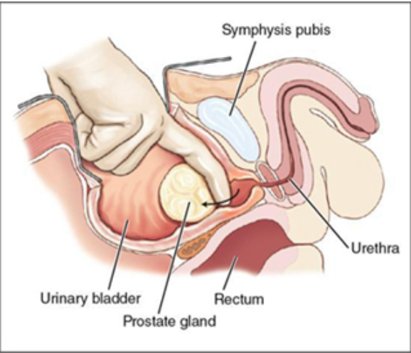 <p>the inside portion of the prostate gland is excised through an abdominal incision made above the pubic bone and through an incision in the bladder and prostate capsule</p><ul><li><p>surgeon uses a finger to remove the hyperplasticity tissue</p></li></ul><p>used to treat <strong>benign prostatic hyperplasia (BPH) </strong>when prostate is very large and meds haven’t worked</p><p>aka <strong>open prostatectomy</strong></p><p>Simple terms: procedure to remove the inside part of the prostate gland to treat an enlarged prostate</p>
