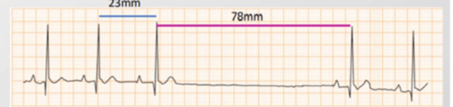 <p>what is this type of arrhythmia?</p>