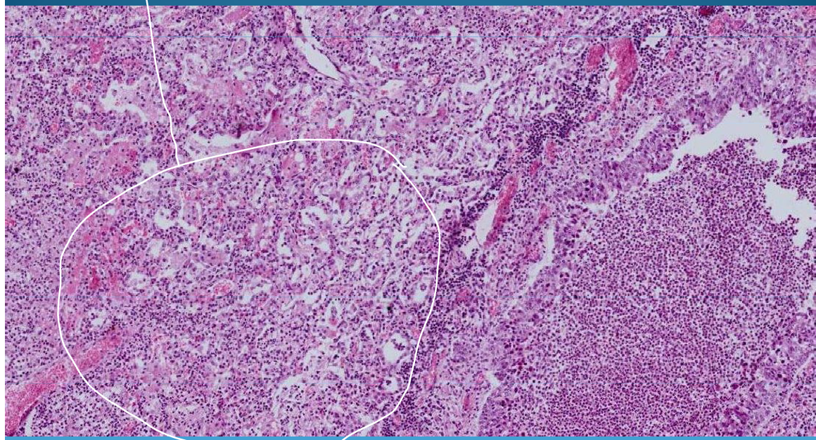 <p>BRONCHIA:</p><p>Bronchopneumonia with polymorphic aspect of alveoli, filled with pus</p>