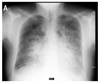 <ul><li><p><strong>Cardiogenic</strong>: This occurs when the <strong>left side of the heart</strong> becomes ineffective and inefficient in pumping blood around the body. This results in a "back up" of blood through the pulmonary vein and into the lungs subsequently causing an increase in the pressure of the pulmonary capillaries, forcing extracellular fluid into the alveoli. Common causes include <span><span>heart failure, myocardial infarction or valve disease</span></span>.</p></li></ul><p></p>