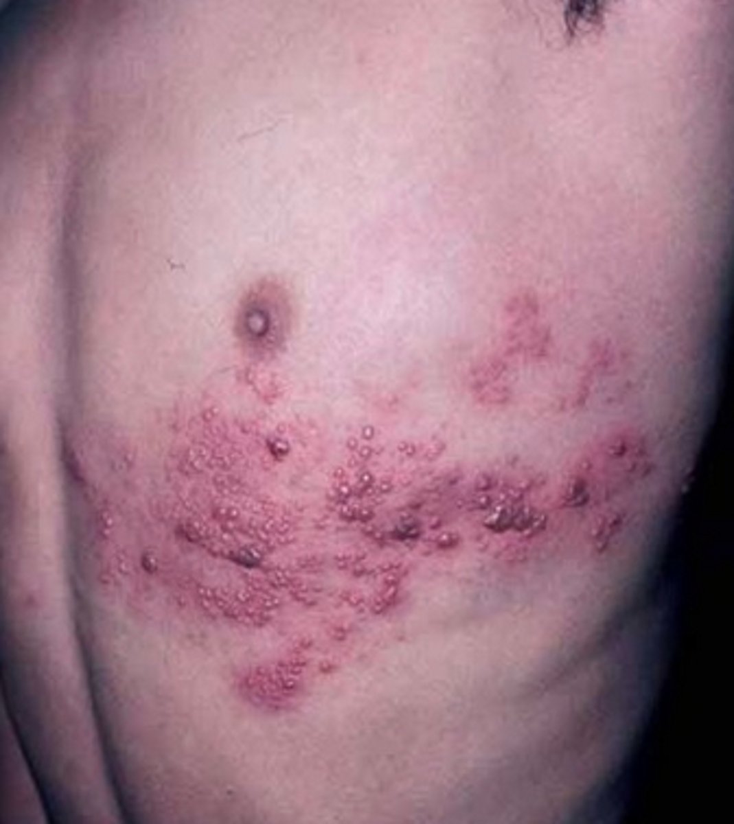 <p>Caused by varicella zoster virus, spread by direct contact to rash, treatment is painkillers, antivirals, and there is a vaccine. (Only if a person has had chicken pox).</p>