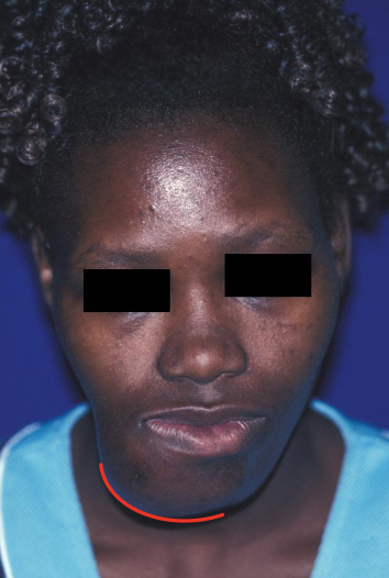 <p><strong>A true bone neoplasm</strong> with significant growth potential composed of <strong>fibrous tissue</strong> that contains a <strong>variable mixture of bone &amp; cementum (central vs. peripheral)</strong></p><p>—&gt; Large tumors result in <strong>painless swelling</strong> </p>