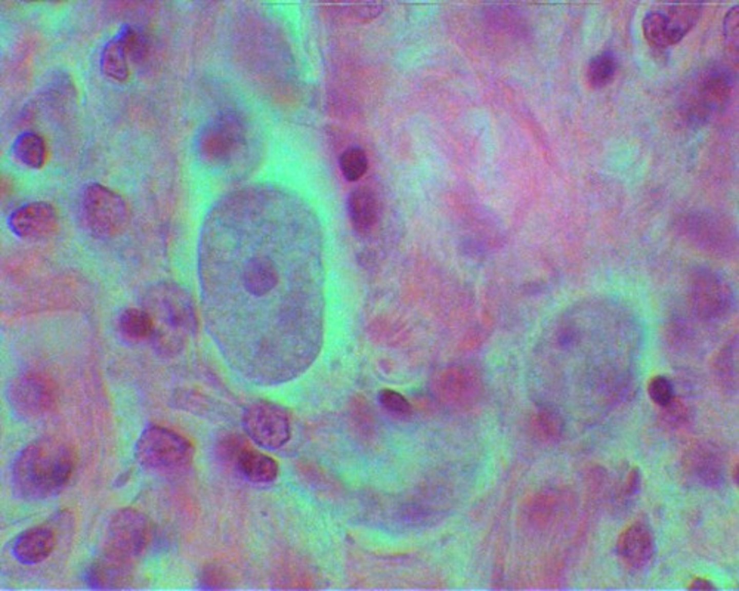 <p>A bacterial infection causing diarrhea (sometimes with blood), leading to dehydration and possible death. Common in the Medieval Eera</p>