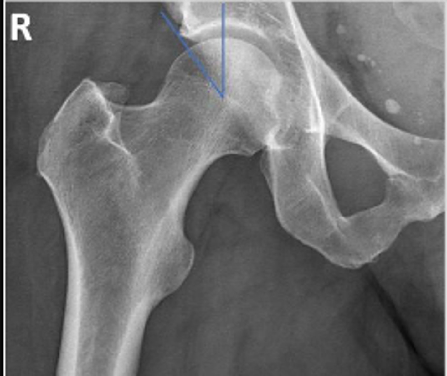 <p>What are the osseous landmarks for this assessment</p>