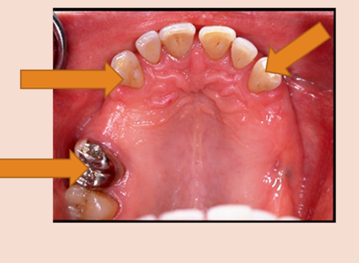 <p>any tooth or crown that receives a direct or indirect retainer</p>
