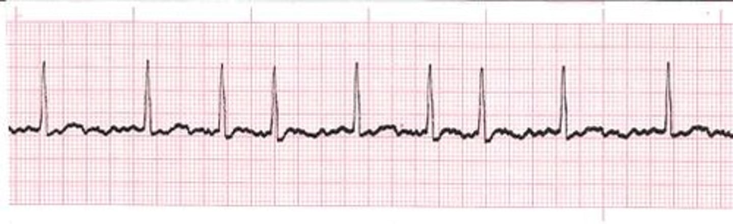 <p>1. Rhythm: regular; 2. Rate: 80 (60 -100); 3. P wave: one in front of every QRS, round, consistent shape; 4. PR interval: 0.16 sec (0.12-0.20); 5. QRS: 0.04 sec (<0.12 sec); 6. ST Segment: no depression or elevation; 7. QT interval: 0.36 sec (0.34-0.42).</p>