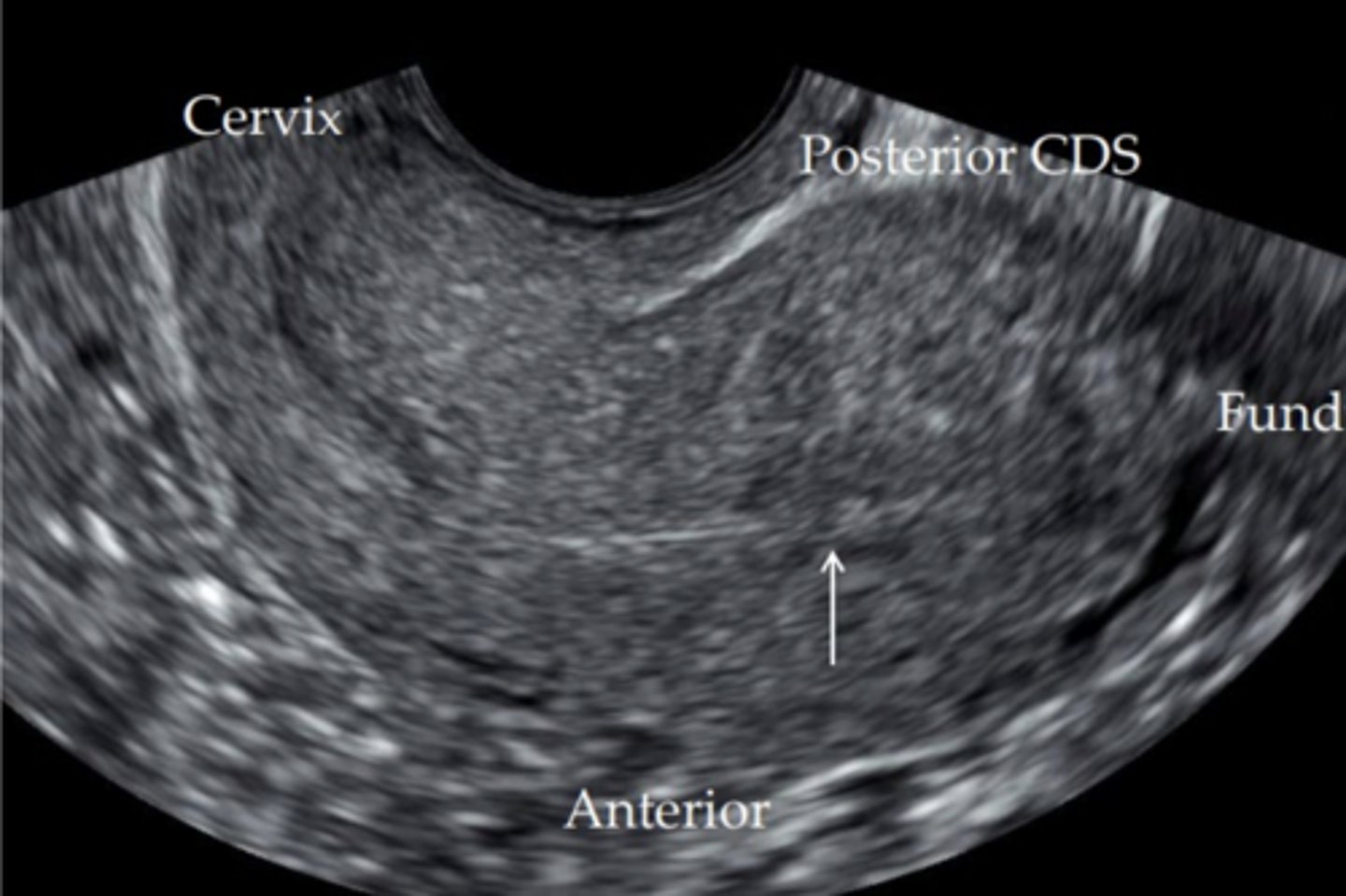 <p>entire uterus is angled posteriorly</p>