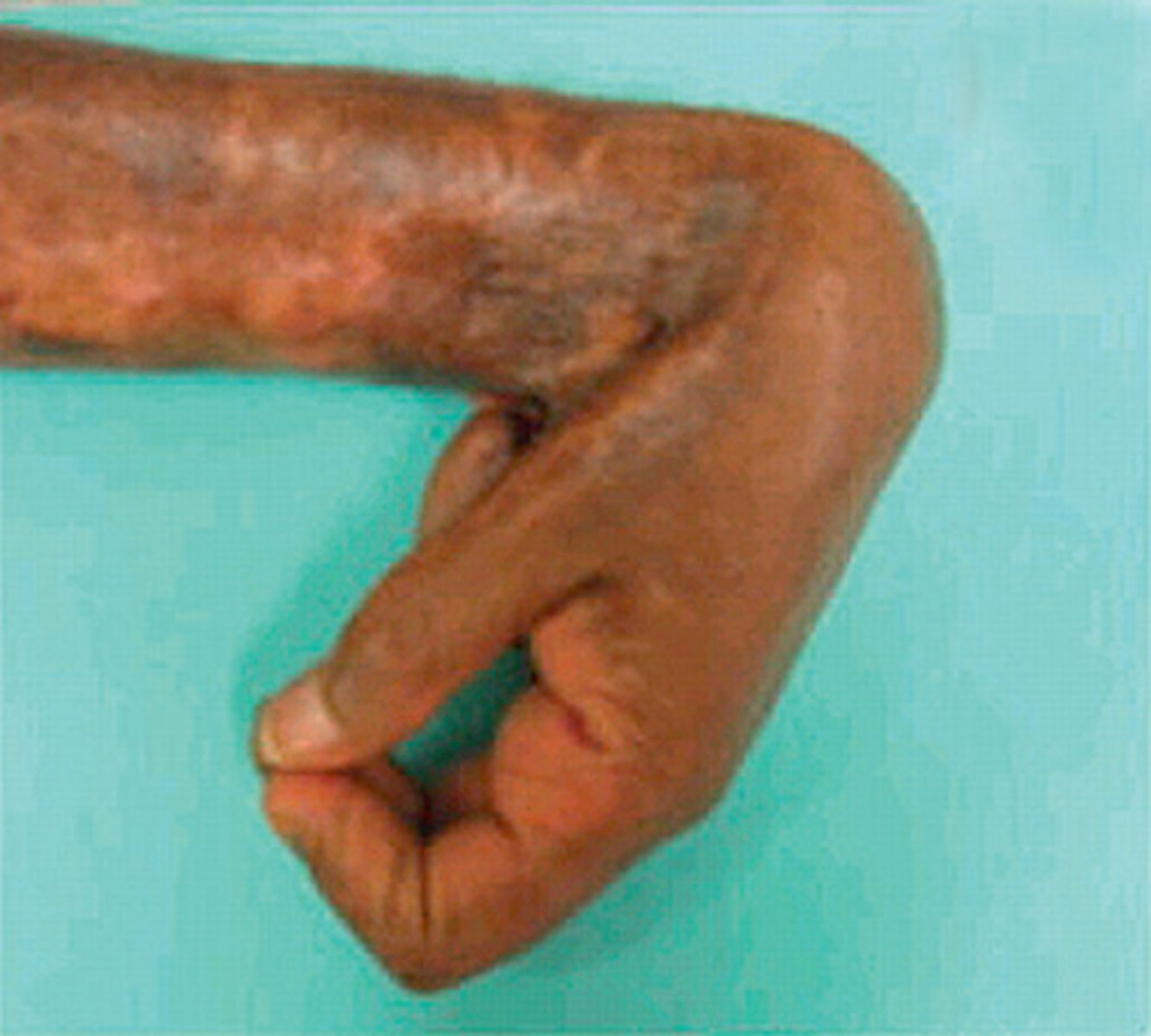 <p>inflexible shrinkage of wound tissue that pulls the edges toward the center of the wound</p>