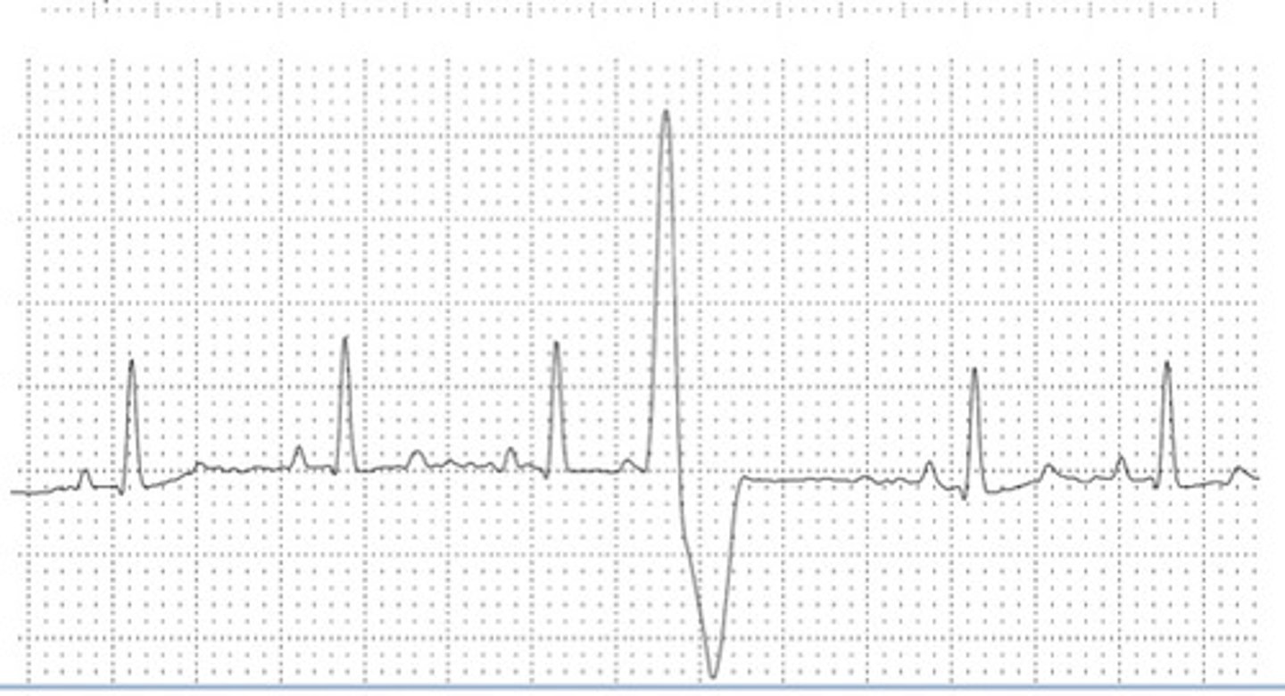 <p>What is the origin of this ECG?</p>