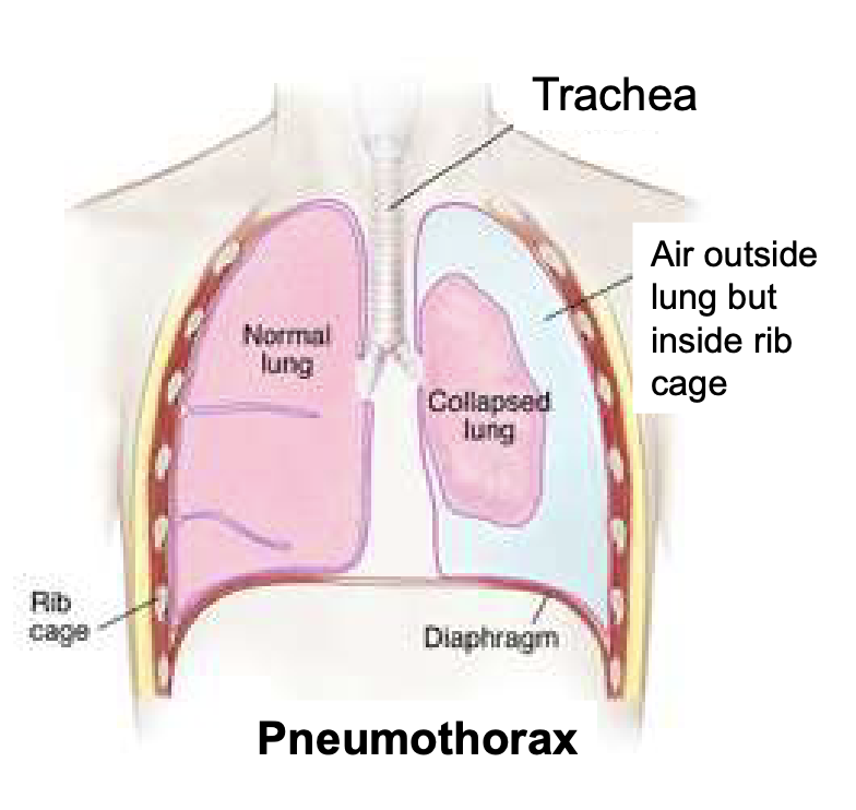 <p>pneumothorax; air entering intrapleural space from outside or from alveoli</p>
