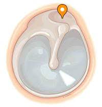 * This is smaller and more compliant 
* Located superiorly 
* It moves easier and is more flaccid 