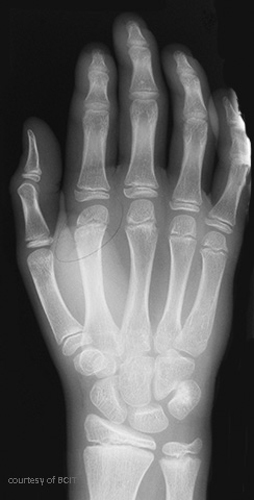 <p>A compression injury to the growth plate and its blood supply.</p>