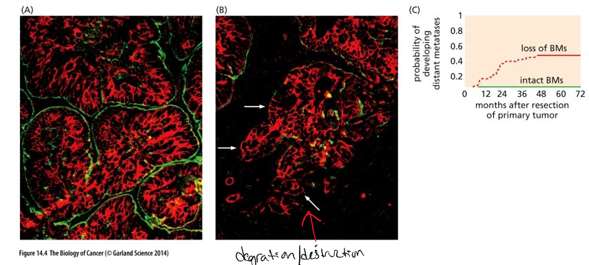<ul><li><p class="Paragraph WhiteSpaceCollapse SCXP116318423 BCX0" style="text-align: left"><span>Carcinomas begin on the epithelial side of the basement membrane (benign if they remain here)​</span></p></li><li><p class="Paragraph WhiteSpaceCollapse SCXP116318423 BCX0" style="text-align: left"><span><strong>Basement membrane </strong>= specialized extra cellular matrix composed of proteins secreted by both stromal and epithelial cells​</span></p></li><li><p class="Paragraph WhiteSpaceCollapse SCXP116318423 BCX0" style="text-align: left"><span><strong>Stroma</strong> is composed of connective tissue (fibroblast cells), blood vessels, lymphatic vessels and nerves​</span></p></li><li><p class="Paragraph WhiteSpaceCollapse SCXP116318423 BCX0" style="text-align: left"><span>(Panels A and B) Green = basement membrane (BM); red = carcinoma cells; black = stroma​</span></p></li><li><p class="Paragraph WhiteSpaceCollapse SCXP116318423 BCX0" style="text-align: left"><span>(A) – less aggressive​</span></p></li><li><p class="Paragraph WhiteSpaceCollapse SCXP116318423 BCX0" style="text-align: left"><span>(B) – more aggressive – loss of BM at white arrows​</span></p></li><li><p class="Paragraph WhiteSpaceCollapse SCXP116318423 BCX0" style="text-align: left"><span>(C) Loss of BM around tumor islands correlates with development metastases 5 years after removal of primary tumors​</span></p></li></ul><p></p>