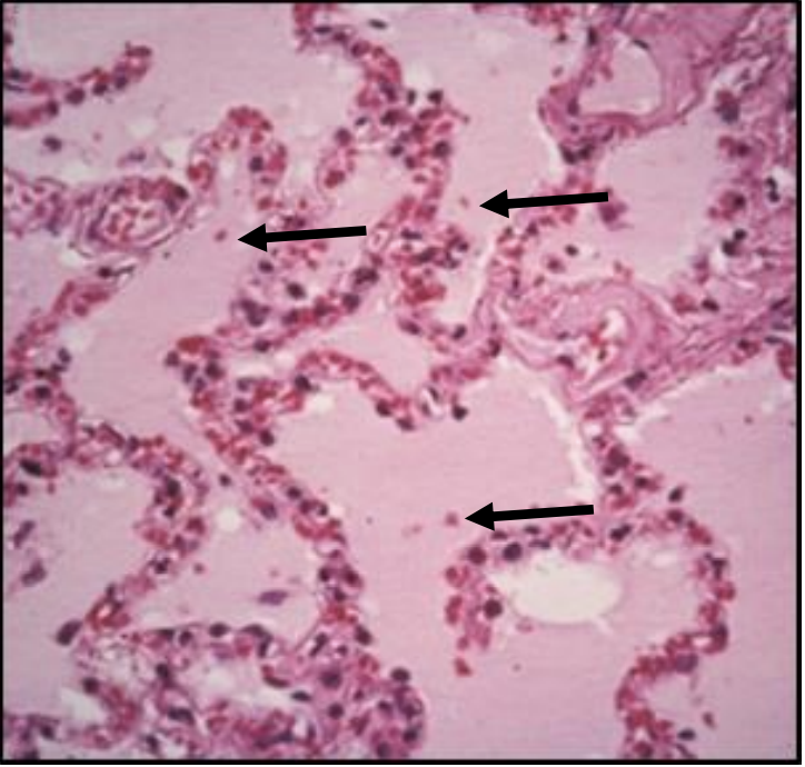 <p>exudate</p>