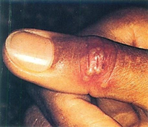 <p>Which Herpes variant is this?</p>