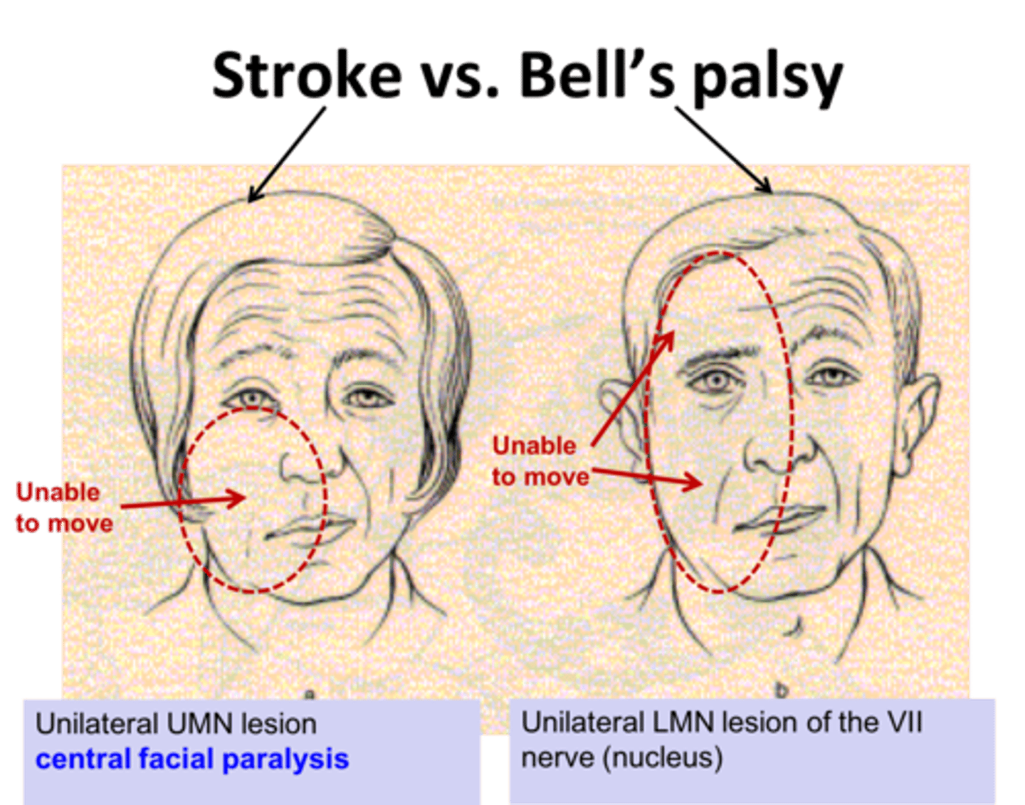 <p>What does a lesion to the Primary Motor Cortex and Premotor Cortex look like?</p>