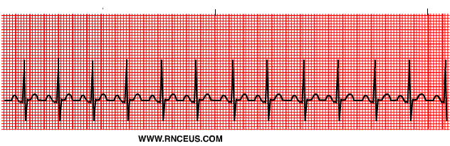 <ul><li><p>increased electrical impulses from SA node</p></li><li><p>heart rate &gt;100 BPM</p></li></ul><p></p>