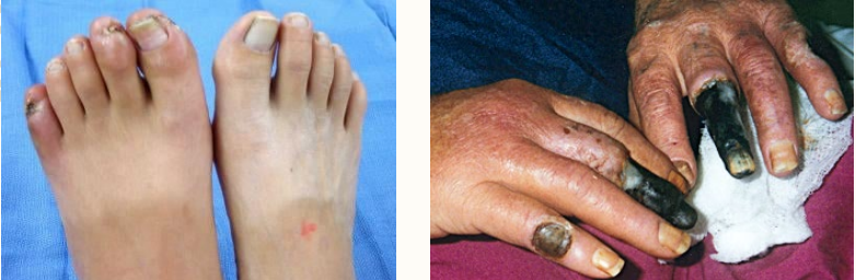 <p><strong>Thromboangiitis Obliterans Clinical Manifestations</strong></p><p>Symptoms</p><p>-Rest _____ of the distal most extremity (toes), early manifestation</p><p>-_________/arthralgia in late disease</p><p></p><p>Physical Exam</p><p>-________ thrombophlebitis</p><p>-Distal extremity ________ to upper and lower extremities </p><p>-_______’_ phenomenon</p><p>-Check all extremities, for this is often present in _+ limbs</p>