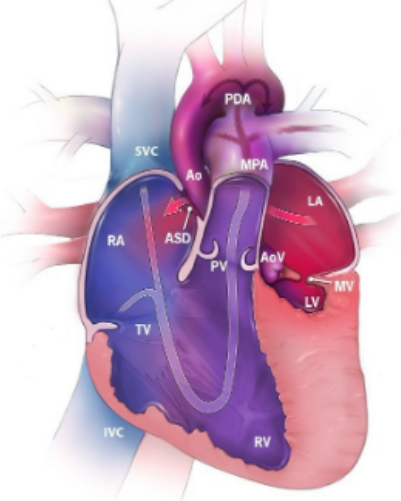 <p>mixed cyanotic, underdevelopment of left-side heart structures (left ventricle, mitral and/or aortic valves, and aorta and aortic arch), nonfunctioning LV is bypassed entirely, ASD typically present and needed to allow oxygenated pulmonary venous blood to mix with deoxygenated venous blood in RA, Prostaglandin E is given to keep PDA until surgery</p>