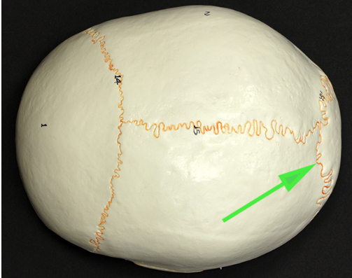 <p>What is the suture marked by the green arrow?</p>