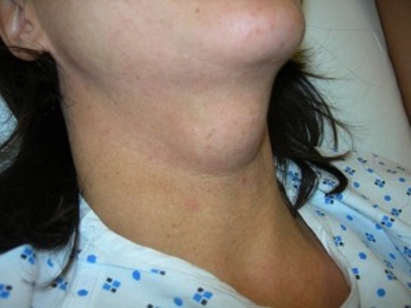<p>cyst forming along the thyroid gland developmental tract - usually below hyoid bone</p>