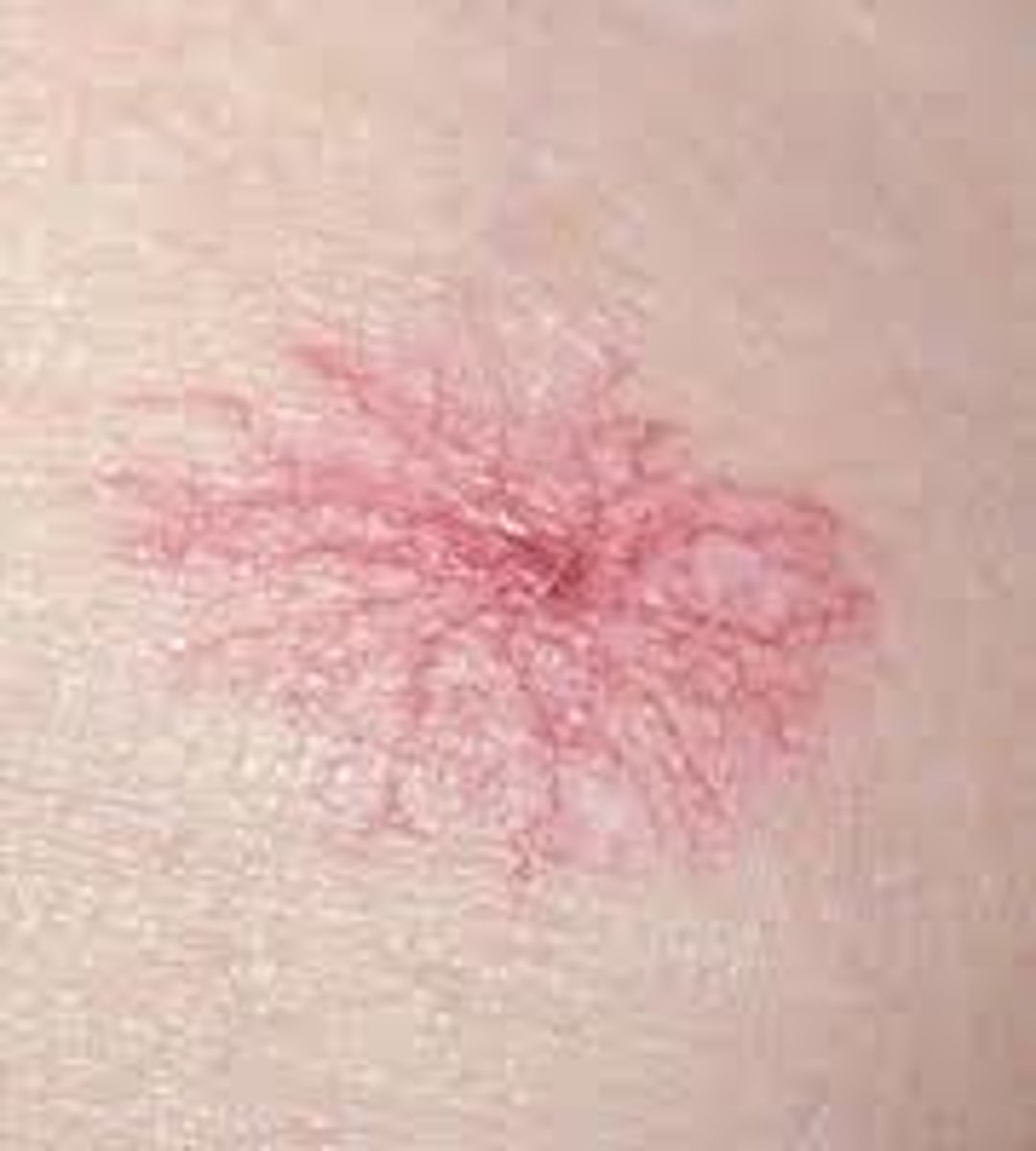 <p>a branched growth of dilated capillaries on the skin, resembling a spider</p>