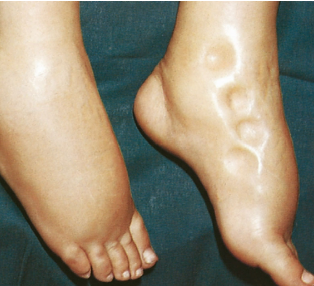 <p>Interstitial Compartment </p>