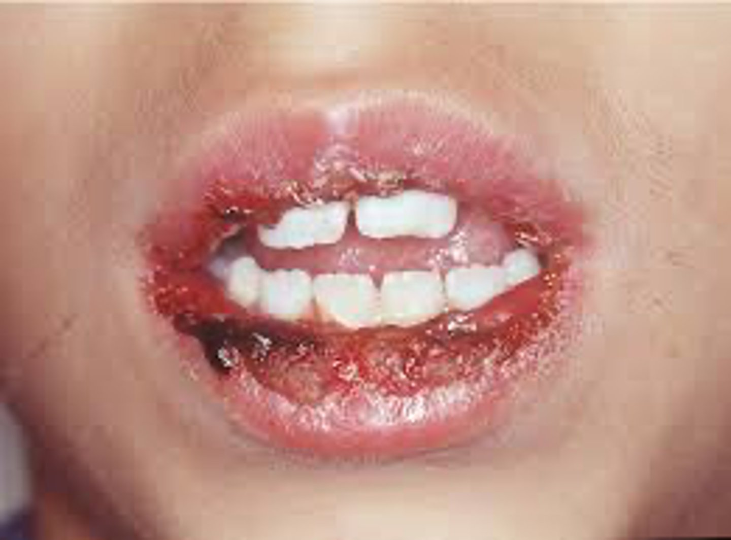 <p>A patient presents with sudden onset of painful oral ulcers and hemorrhagic crusting of the lips. What is the most likely diagnosis?</p>