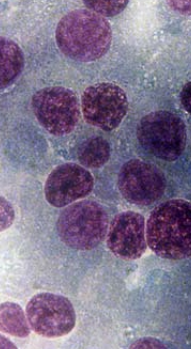 <ul><li><p><span style="color: red"><strong>Benign:</strong></span> <u>pituitary</u> adenoma, <u>thyroid</u> adenoma</p></li><li><p><span style="color: red"><strong>Malignant:</strong></span> <u>thyroid</u> carcinoma, <u>insulinoma (pancreas) </u></p></li><li><p><strong>Free</strong>/<strong><u>naked nuclei</u></strong> in a sea of cytoplasm</p></li><li><p><strong><u>Exfoliates well</u></strong></p></li></ul><p></p>