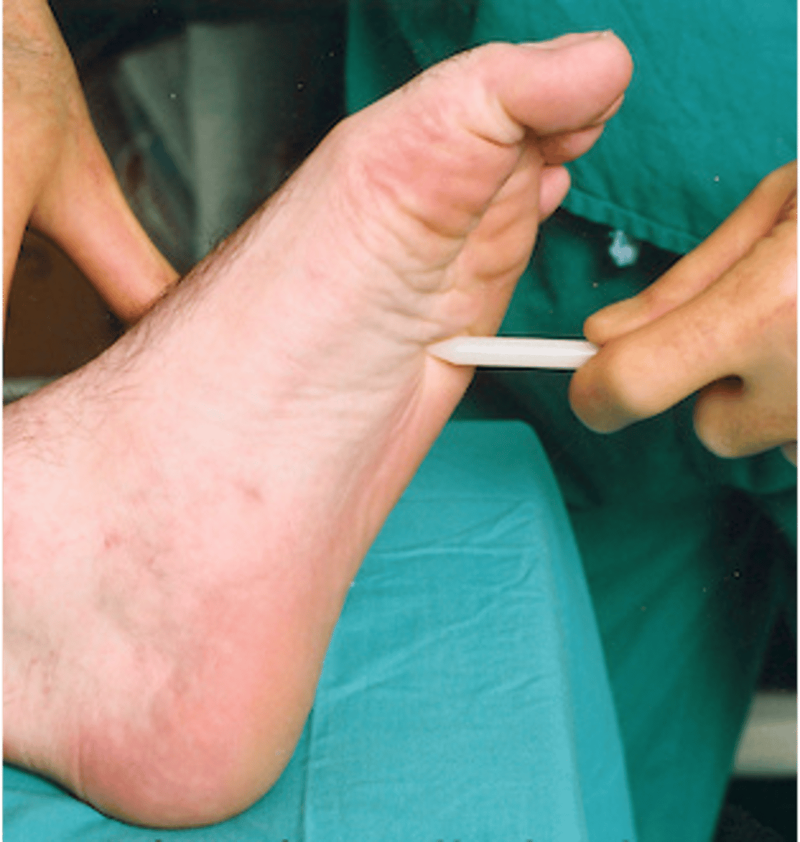 <p>Babinski reflex</p>