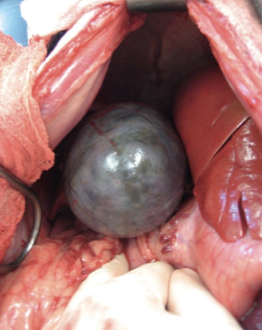 <p>- Cystic mucosal hyperplasia resulting in hypersecretion of mucus and thick, gelatinous bile within the gall bladder which is generally sterile</p><p>- This can lead to obstruction and rupture</p>