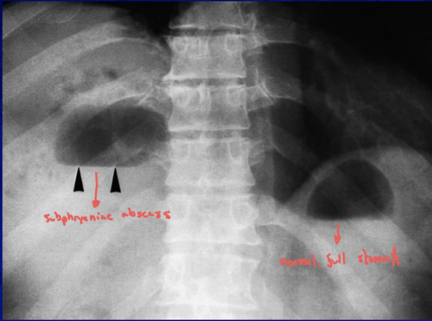 <p>pleural effusion or pulmonary</p><p>collapse/consolidation</p>