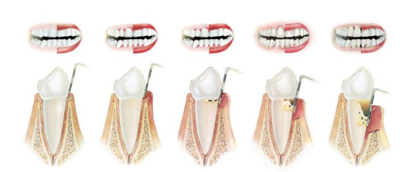 <p>goes from a more yellow color to a black color; gets more black bc it has more hemoglobin in it </p>