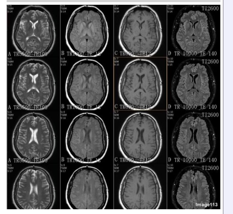 <p><span>&nbsp;Which column in Image 113 would be best suited for evaluation of demyelinating disease?</span></p><p><span>&nbsp;A. Column A</span></p><p><span>&nbsp;B. Column B</span></p><p><span>&nbsp;C. Column C</span></p><p><span>&nbsp;D. Column D</span></p>
