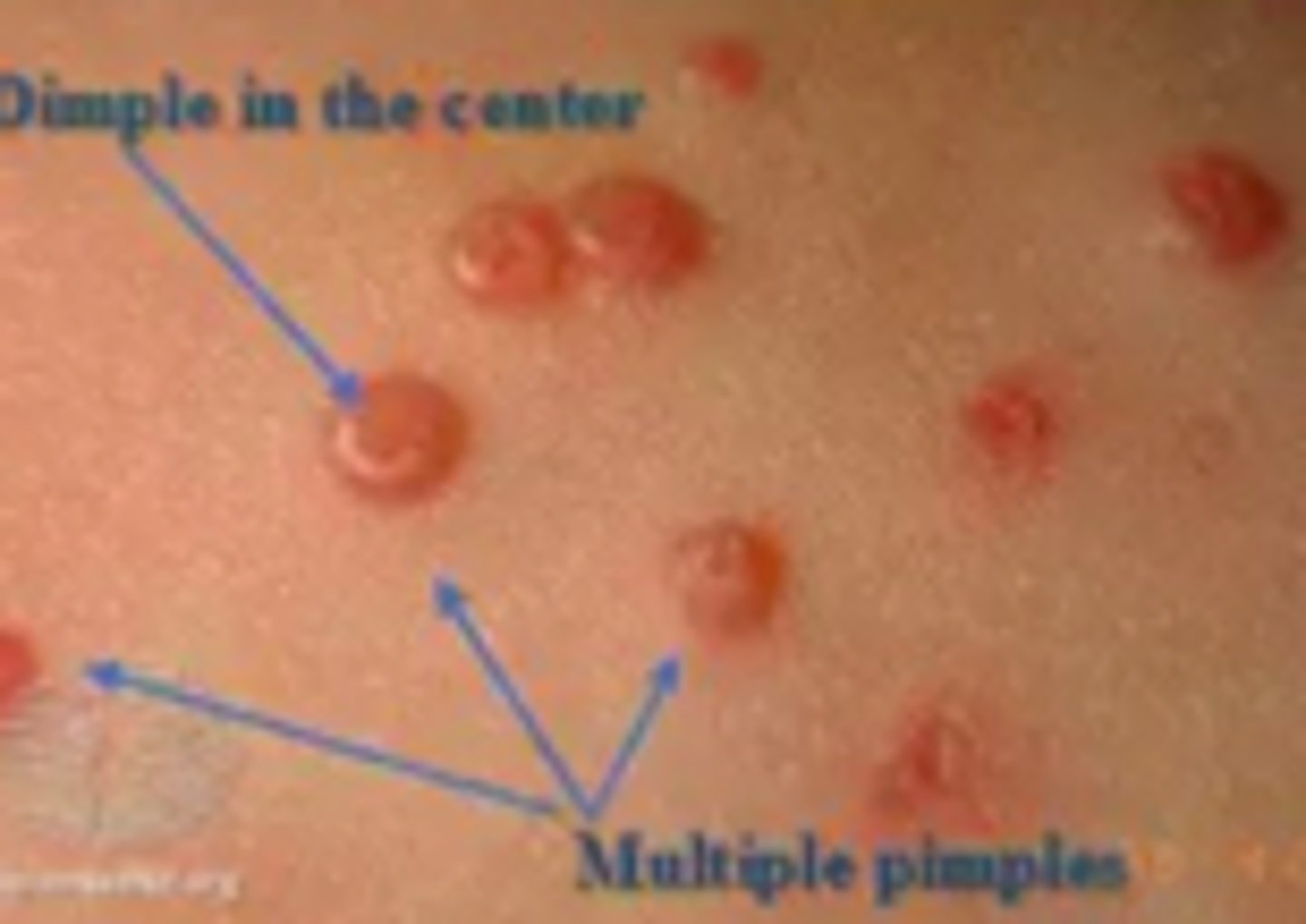 <p>Viral ID:</p><p>Overview:</p><p>Poxvirus that causes a chronic, localized infection, consisting of skin-colored, dome-shaped papules on skin of infected individual</p><p>Common childhood disease</p><p>Often occurs in healthy adolescents and adults, often as sexually transmitted disease or in relation to participation in contact sports</p><p>Also associated with immunodeficiency states</p><p>Spread by direct skin-to-skin contact, and also by autoinoculation by scratching/touching lesion</p><p>Can also be spread via fomites (bath sponges, towels) or through skin contact during contact sport participation</p><p>Classified as STD when occurring in genital region in sexually active individuals</p><p>Estimates for the incubation period of the virus vary from 1 week to 6 months; typically between 2-6 weeks</p>