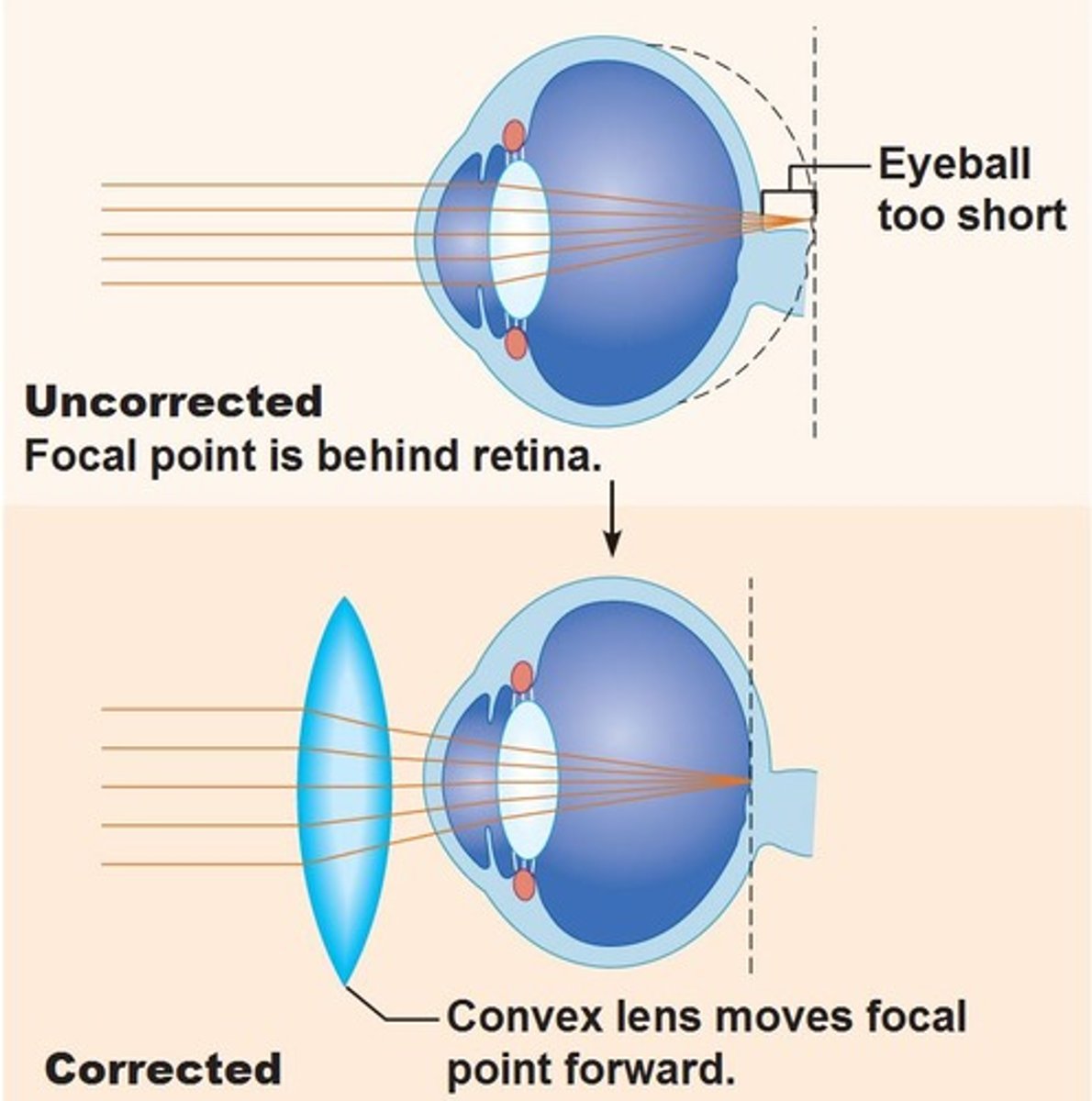 <p>Eyeball too short, causes hyperopia (farsightedness), focal point is behind the retina; <strong>convex</strong> lens</p>