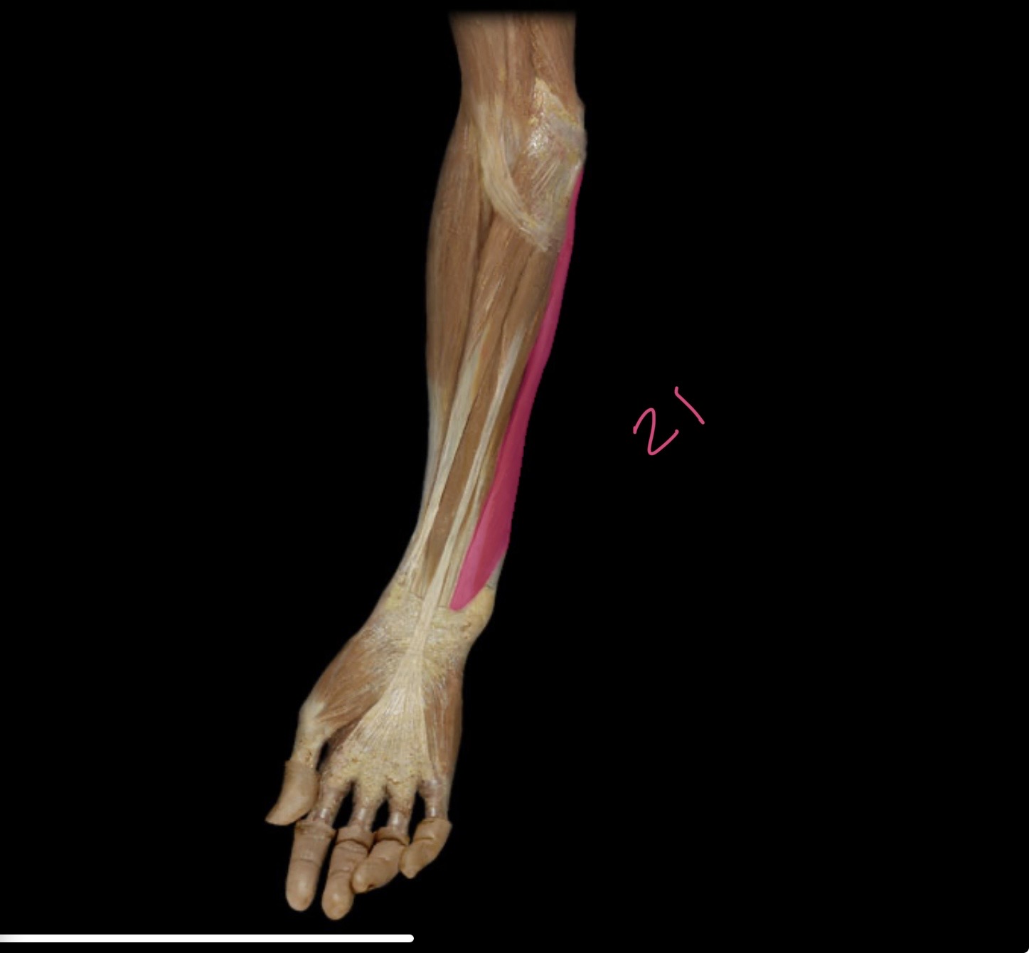 <p>Flexor carpi ulnaris</p>