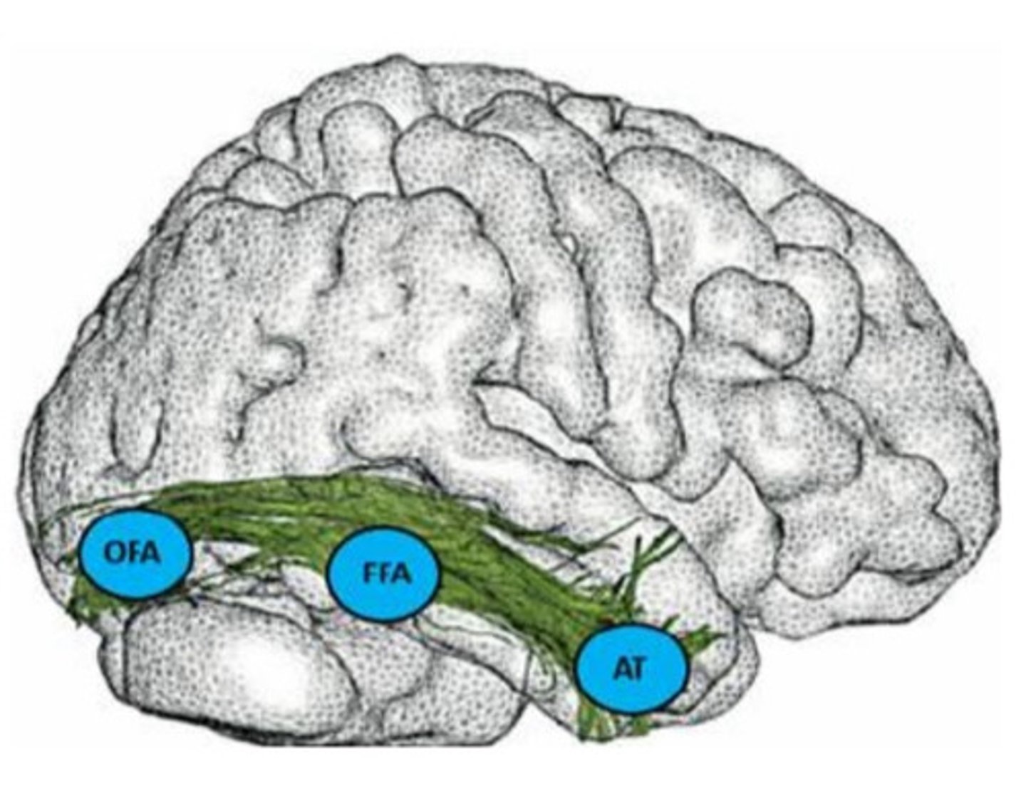 <p>bilateral occipito-temporal damage</p>