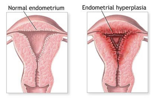 <p>Hyperplasia example</p>
