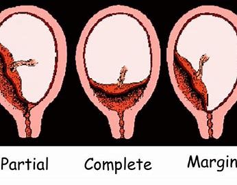 <p>Placenta Previa</p>