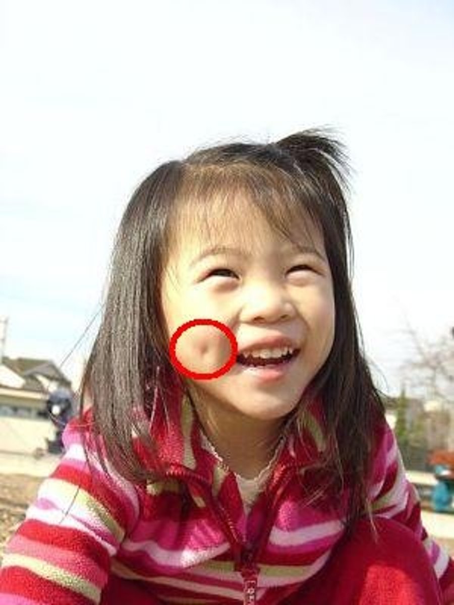<p>indentations on the cheek or chin</p>