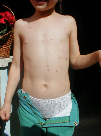 <ul><li><p>Raised,red itchy spots </p></li><li><p>Fluid-filled vesicles </p></li><li><p>Within 5 days, it crusts over </p></li></ul><p></p>