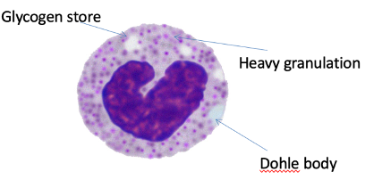 <ul><li><p><span>WBCs are released from marrow early – do not have a lobular nucleus</span></p></li><li><p class="MsoListParagraphCxSpMiddle"><span>Dohle bodies present – synthesis of proteins to increase the n.o granules present that will be highly active</span></p><ul><li><p class="MsoListParagraphCxSpMiddle"><span>Highly activated cell – senses surrounding environment – sensitisation – regular outline of cell ready to fight infection</span></p></li></ul></li><li><p class="MsoListParagraphCxSpMiddle"><span>Cytokines and chemokines that are released during inflammation.</span></p></li><li><p class="MsoListParagraphCxSpMiddle"><span>These enhance neutrophil function → Enhanced adhesion and movement</span></p></li></ul><p></p>