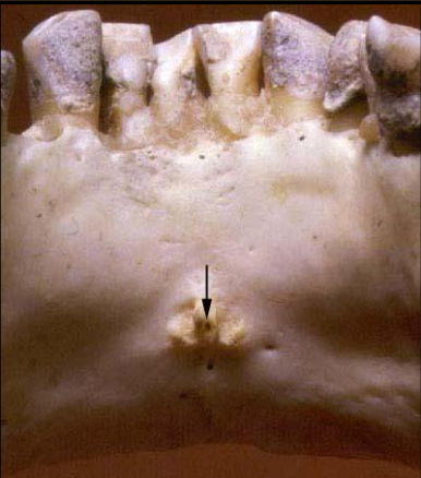 <p>Lingual Foramen</p><ul><li><p>tiny opening or hole in the bone located on the internal  surface of the mandible (lingual) </p><ul><li><p>inside the genial tubercles</p></li></ul></li><li><p><u>Radiographic: small </u><strong><u>radiolucent dot</u></strong><u> inferior to the apices of the mandibular incisors </u></p></li></ul><p></p>
