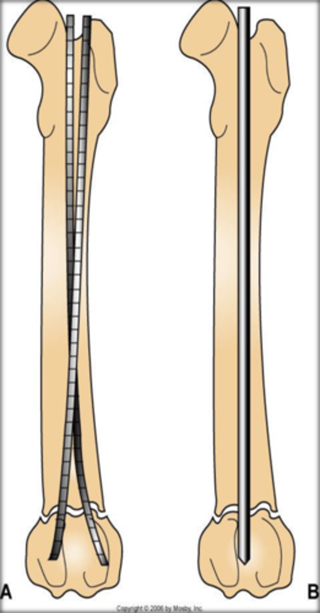 <p>-poor at axial compression unless bone column reinstated. bone generally reformed with aid of cerclage wires</p><p>-increase in pin diameter results in disproportionate increase in strength</p><p>-transverse fracture allows rotation so need plate as well or external fixator</p>