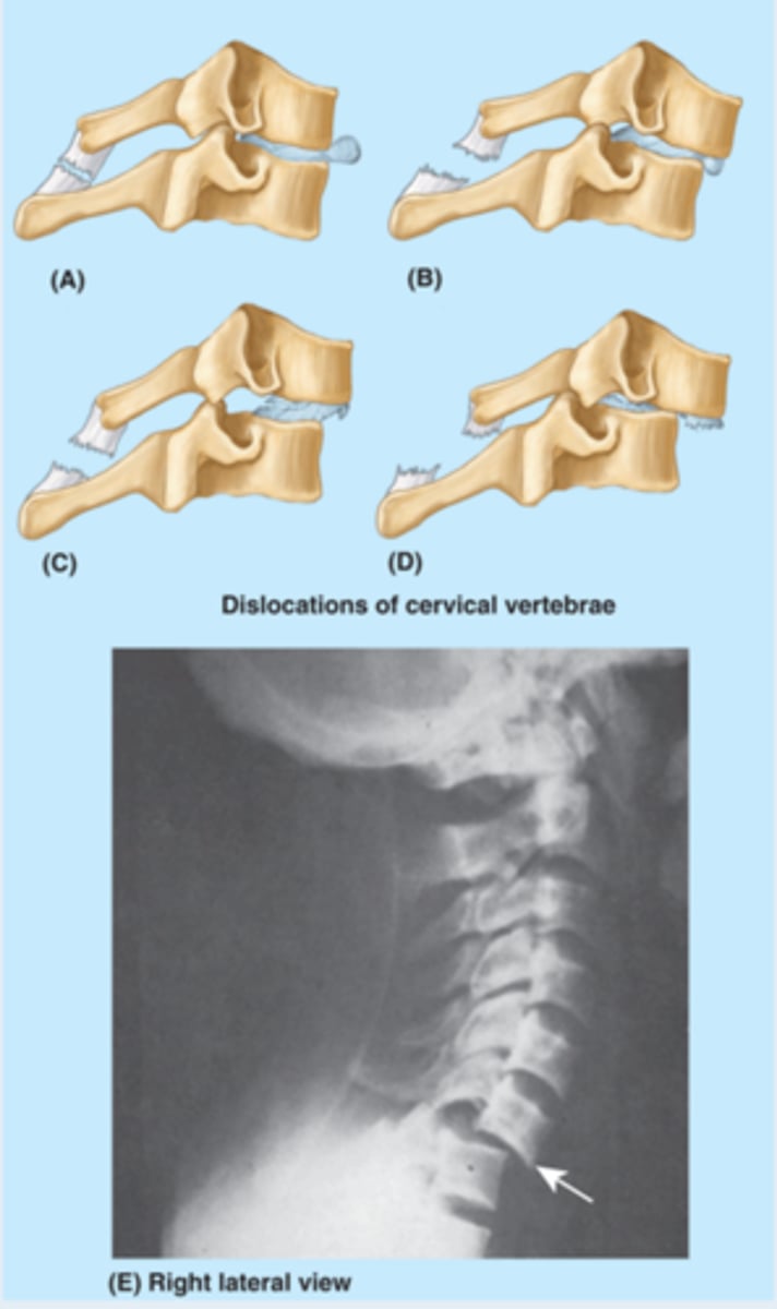<p>traumatic</p><p>- may cause cord compression</p><p>- requires surgical stabilization</p><p>- unilateral versus bilateral (superior subluxation or dislocation due to forced flexion)</p>