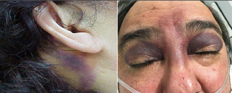 <p>Basilar skull fracture following head trauma</p>